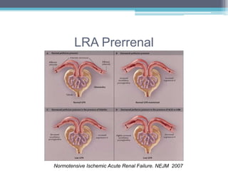 LRA Prerrenal 
Normotensive Ischemic Acute Renal Failure. NEJM 2007 
 
