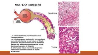 Necrosis tubular aguda
 