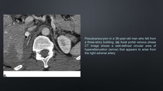 lesi-n-vascular-en-trauma-abdominal-cerrado-kenny-diaz-pptx