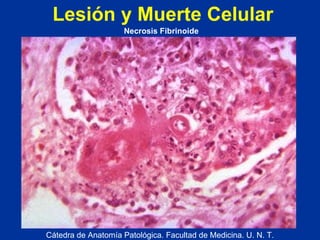 Lesión y Muerte Celular Cátedra de Anatomía Patológica. Facultad de Medicina. U. N. T. Necrosis Fibrinoide 