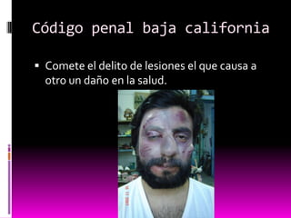 Código penal baja california
 Comete el delito de lesiones el que causa a
otro un daño en la salud.
 