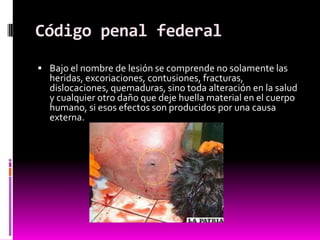 Código penal federal
 Bajo el nombre de lesión se comprende no solamente las
heridas, excoriaciones, contusiones, fracturas,
dislocaciones, quemaduras, sino toda alteración en la salud
y cualquier otro daño que deje huella material en el cuerpo
humano, si esos efectos son producidos por una causa
externa.
 