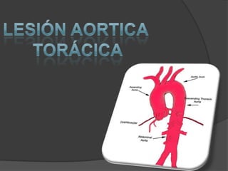 Lesión aortica  torácica 