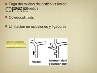 CPRE
Fuga del muñon del cistico vs lesion
intra/extrehepatica
Coledocolitiasis
Limitacion en oclusiones y ligaduras
e missed on ERCP (6). Aberrant right posterior
segmental duct injuries are often suspected in the
setting of clinical or imaging evidence of a bile leak
(perihepatic fluid collection on postcholecystectomy
cross-sectional imaging or copious bil- ious output
from surgical drains) but “normal” ERCP
e missed on ERCP (6). Aberrant right posterior
segmental duct injuries are often suspected in the
setting of clinical or imaging evidence of a bile leak
(perihepatic fluid collection on postcholecystectomy
cross-sectional imaging or copious bil- ious output
from surgical drains) but “normal” ERCP
 