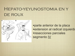 Hepato-yeyunostomia en y
de roux
•parte anterior de la placa
•extension al radical izquierdo
•resecciones parciales
segmento IV
 