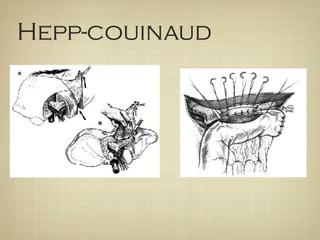 Hepp-couinaud
 