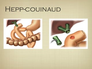Hepp-couinaud
 