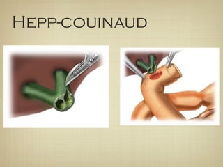 Hepp-couinaud
 