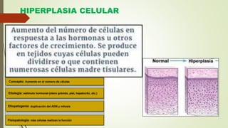 HIPERPLASIA CELULAR
 