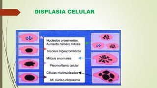 DISPLASIA CELULAR
 