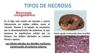 Necrosis
Iinfarto agudo al miocardio (área amarilla)
Las células pierden los detalles nucleares,
conservando el contorno externo.
coagulativa
Es el tipo más común de necrosis y ocurre
típicamente en tejidos sólidos como el
corazón, riñones y el hígado. Se caracteriza
por la desnaturalización de proteínas, lo que
preserva la arquitectura celular por un
tiempo. Los tejidos afectados se vuelven
firmes y opacos.
 