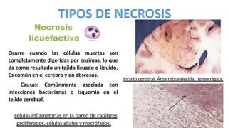 Necrosis
licuefactiva
Caracterizada por digestión de
nicóticas
células inflamatorias en la pared de capilares
proliferados, células gliales y macrófagos.
Infarto cerebral. Área reblandecida, hemorrágica.
Ocurre cuando las células muertas son
completamente digeridas por enzimas, lo que
da como resultado un tejido licuado o líquido.
Es común en el cerebro y en abscesos.
Causas: Comúnmente asociada con
infecciones bacterianas o isquemia en el
tejido cerebral.
 