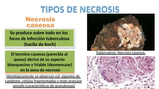 Necrosis
caseosa
Se produce sobre todo en los
focos de infección tuberculosa
(bacilo de Koch)
El termino caseosa (parecida al
queso) deriva de su aspecto
blanquecino y friable (desmenuzar)
en la zona de necrosis
Tuberculosis. Necrosis caseosa.
Histológicamente se observan cel. gigantes de
Langhans, células fragmentadas y resto granular
amorfo (características de granulomas)
 