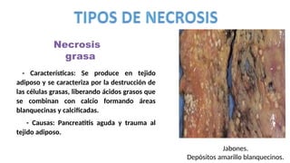 Necrosis
grasa
.
Jabones.
Depósitos amarillo blanquecinos.
- Características: Se produce en tejido
adiposo y se caracteriza por la destrucción de
las células grasas, liberando ácidos grasos que
se combinan con calcio formando áreas
blanquecinas y calcificadas.
- Causas: Pancreatitis aguda y trauma al
tejido adiposo.
 