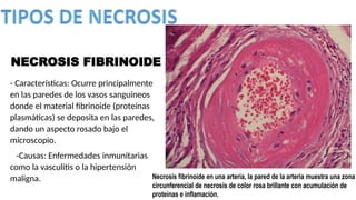- Características: Ocurre principalmente
en las paredes de los vasos sanguíneos
donde el material fibrinoide (proteínas
plasmáticas) se deposita en las paredes,
dando un aspecto rosado bajo el
microscopio.
-Causas: Enfermedades inmunitarias
como la vasculitis o la hipertensión
maligna.
NECROSIS FIBRINOIDE
 