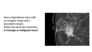 Here a hyperdense mass with
an irregular shape and a
spiculated margin.
Notice the focal skin retraction.
Is it benign or malignant mass?
 