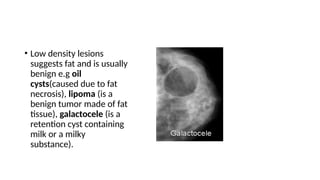 • Low density lesions
suggests fat and is usually
benign e.g oil
cysts(caused due to fat
necrosis), lipoma (is a
benign tumor made of fat
tissue), galactocele (is a
retention cyst containing
milk or a milky
substance).
 