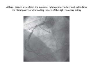 A Kugel branch arises from the proximal right coronary artery and extends to
the distal posterior descending branch of the right coronary artery
 