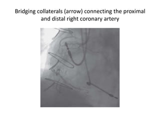 Bridging collaterals (arrow) connecting the proximal
and distal right coronary artery
 