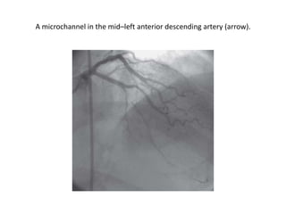 A microchannel in the mid–left anterior descending artery (arrow).
 