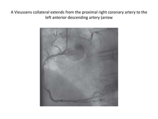 A Vieussens collateral extends from the proximal right coronary artery to the
left anterior descending artery (arrow
 