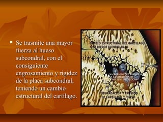  SSee ttrraassmmiittee uunnaa mmaayyoorr 
ffuueerrzzaa aall hhuueessoo 
ssuubbccoonnddrraall,, ccoonn eell 
ccoonnssiigguuiieennttee 
eennggrroossaammiieennttoo yy rriiggiiddeezz 
ddee llaa ppllaaccaa ssuubbccoonnddrraall,, 
tteenniieennddoo uunn ccaammbbiioo 
eessttrruuccttuurraall ddeell ccaarrttííllaaggoo.. 
 