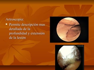 AArrttrroossccooppiiaa:: 
 PPeerrmmiittee ddeessccrriippcciióónn mmaass 
ddeettaallllaaddaa ddee llaa 
pprrooffuunnddiiddaadd yy eexxtteennssiióónn 
ddee llaa lleessiióónn 
 