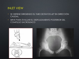 Comprehensive Overview of Pelvic Fractures: Diagnosis, Classification ...