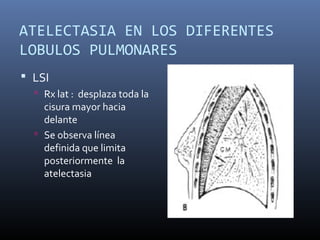 ATELECTASIA EN LOS DIFERENTES
LOBULOS PULMONARES
 LSI
 Rx lat : desplaza toda la
cisura mayor hacia
delante
 Se observa línea
definida que limita
posteriormente la
atelectasia
 
