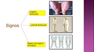 Signos
ATROFIA
MUSCULAR
LAXITUD MUSCULAR
RODILLA EN VARO O
EN VALGO
 