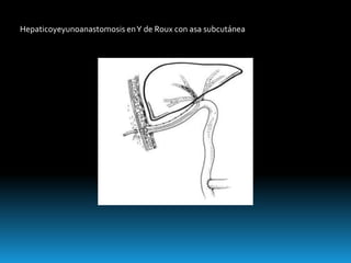 Hepaticoyeyunoanastomosis enY de Roux con asa subcutánea
 