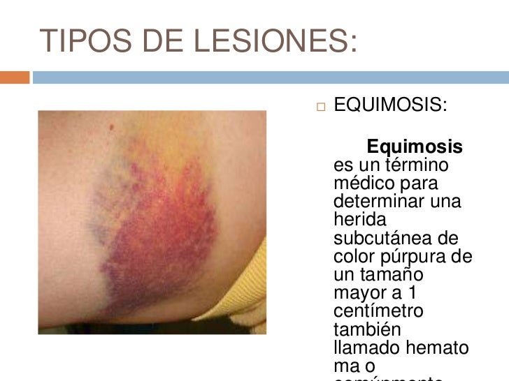 Se ha hinchado el dedo en la mano cerca de la uña como curar