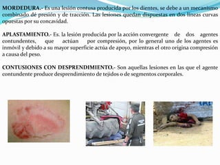 MORDEDURA.- Es una lesión contusa producida por los dientes, se debe a un mecanismo 
combinado dé presión y de tracción. Las lesiones quedan dispuestas en dos líneas curvas 
opuestas por su concavidad. 
APLASTAMIENTO.- Es. la lesión producida por la acción convergente de dos agentes 
contundentes, que actúan por compresión, por lo general uno de los agentes es 
inmóvil y debido a su mayor superficie actúa de apoyo, mientras el otro origina compresión 
a causa del peso. 
CONTUSIONES CON DESPRENDIMIENTO.- Son aquellas lesiones en las que el agente 
contundente produce desprendimiento de tejidos o de segmentos corporales. 
 