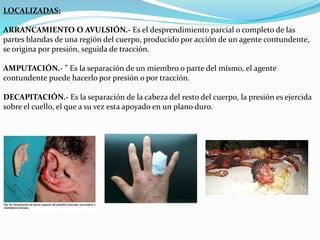 LOCALIZADAS: 
ARRANCAMIENTO O AVULSIÓN.- Es el desprendimiento parcial o completo de las 
partes blandas de una región del cuerpo, producido por acción de un agente contundente, 
se origina por presión, seguida de tracción. 
AMPUTACIÓN.- ” Es la separación de un miembro o parte del mismo, el agente 
contundente puede hacerlo por presión o por tracción. 
DECAPITACIÓN.- Es la separación de la cabeza del resto del cuerpo, la presión es ejercida 
sobre el cuello, el que a su vez esta apoyado en un plano duro. 
 