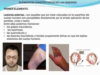 ELEMENTOS CONSTITUTIVOS DE LAS LESIONES 
PRIMER ELEMENTO 
Lesiones externas.- son aquellas que por estar colocadas en la superficie del 
cuerpo humano son perceptibles directamente por la simple aplicación de los 
sentidos, (vista o tacto). 
Entre ellas podemos mencionar: 
• los golpes traumáticos, 
• las equimosis, 
• las quemaduras y 
• las lesiones traumáticas o heridas propiamente dichas en que los tejidos 
exteriores del cuerpo humano. 
 