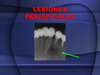 LESIONES
PERIAPICALES

 