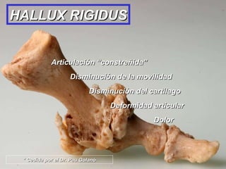 Articulación “constreñida” Disminución de la movilidad Disminución del cartílago Deformidad articular   Dolor HALLUX RIGIDUS * Cedida por el Dr. Pau Golanó 