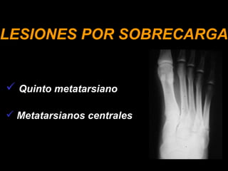 LESIONES POR SOBRECARGA Quinto metatarsiano Metatarsianos centrales 