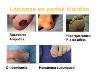 Lesiones en partes blandas Rozaduras Ampollas Hiperqueratosis Pie de atleta Hematoma subungueal  Onicomicosis  