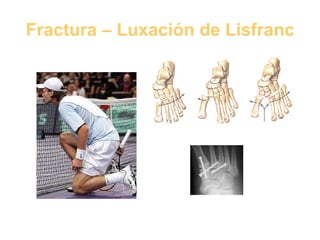 Fractura – Luxación de Lisfranc 
