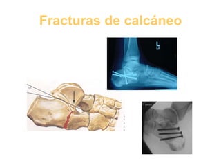 Fracturas de calcáneo 