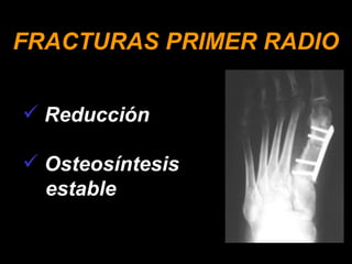 FRACTURAS PRIMER RADIO Reducción Osteosíntesis estable 