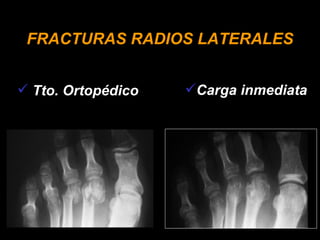 FRACTURAS RADIOS LATERALES Tto. Ortopédico Carga inmediata 