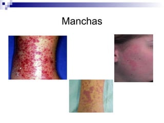 Manchas 