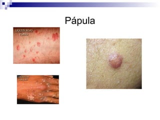 Pápula 