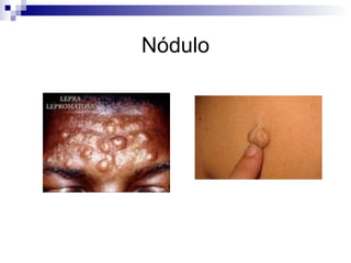 Nódulo 