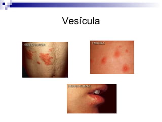 Vesícula 