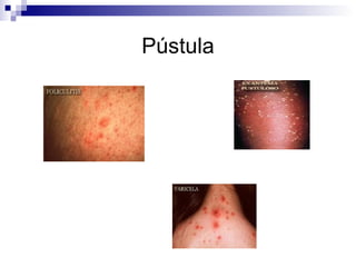 Pústula 