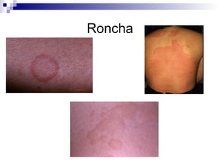 Roncha 