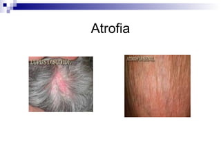 Atrofia 